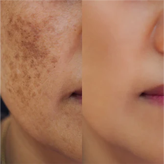 Before After
