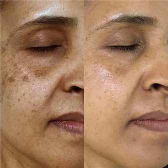 Before After