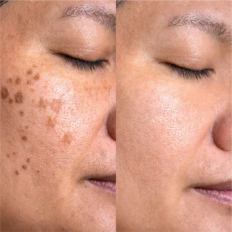 Before After